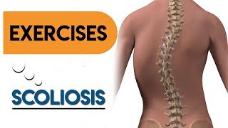 Effective Scoliosis Exercises at Home [upl. by Aikam]