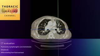 CT assessment  evaluating pulmonary lymphangitis carcinomatosis [upl. by Tildy]