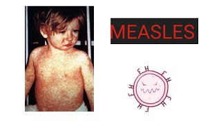 MEASLES Causes Pathology Symptoms Diagnosis Treatment Vaccination Care  What is Measles [upl. by Leta855]