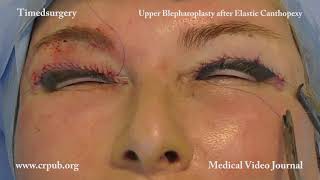 20 Upper Blepharoplasty after Elastic Canthopexy [upl. by Schifra]