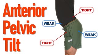 How To Fix Anterior Pelvic Tilt  4 Easy Exercises [upl. by Ennelram]