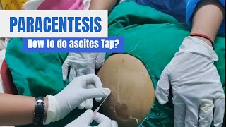 Paracentesis Procedure Ascites Tap in detail [upl. by Eecyak720]