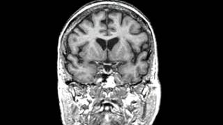 Normal Aging Coronal Plane motion picture [upl. by Milissa]