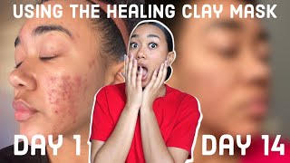 I Used The Healing Clay Mask EVERYDAY CRAZY RESULTS  How Bentonite Clay Cleared My Acne [upl. by Burger]