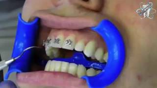 Watch how dentist put your braces on [upl. by Rese]