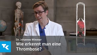 Wie erkennt man eine Thrombose  Dr Johannes Wimmer [upl. by Aicala]