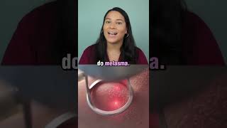 Tratar ou não tratar o melasma estética pele melasma [upl. by Eednas]