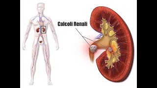 Soffri di calcoli renali Evita questi alimenti per non formare calcoli renaliVideo informativo [upl. by Ainessey105]