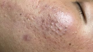 ACNE TREATMENT VU QUYNH MI Blackheads On Boy Face 2024 [upl. by Almap889]