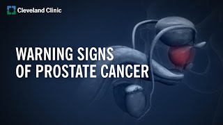 10 Warning Signs of Prostate Cancer [upl. by Jecoa406]