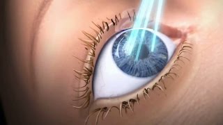 LASIK  animiertes Erklärvideo  MUNICH EYE [upl. by Naleek]