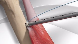 Spinal Cord Injury Causes Effects and Classifications [upl. by Hguh658]