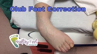 Club Foot Correction Before and After [upl. by Cadel217]