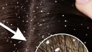 attaulla doctor ka dandruff powder IraamCookingsVlogs [upl. by Ewan]