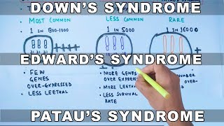 Trisomy  Downs vs Edwards vs Pataus Syndrome [upl. by Yznel]