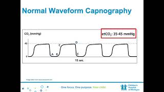 Waveform Capnography Implementation [upl. by Nivloc]