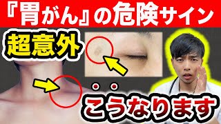 【放置危険】その皮膚の変化『胃がん』のサインです。知らないと後悔する、５つの病変。【現役医師が意外な症状と発がんリスクをアニメ解説】ピロリ菌は〇〇してください… [upl. by Avahc]