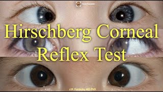 Hirschberg Corneal Reflex Test Principles and Procedure [upl. by Sofie]