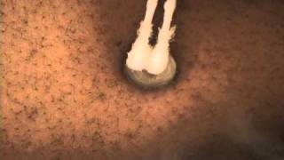 NonSurgical Keloid Treatment with Cryotherapy [upl. by Odnamra]