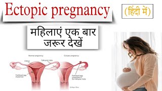 Ectopic pregnancy ectopic pregnancy sign and symptoms [upl. by Argella494]