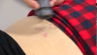 Removing Red Ink with 532nm at Newcastle Tattoo Removal [upl. by Chatterjee443]