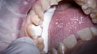 Biodentine  amalgam replacement on a large MOL cavity [upl. by Gemoets854]