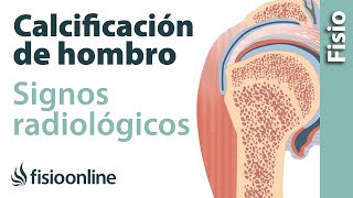 Calcificación de hombro en manguito rotador Signos radiológicos [upl. by Accire]