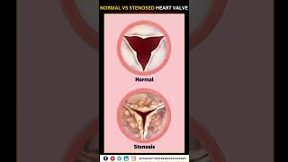 Normal vs Narrowed Stenosed Heart Valve education neet biology heart [upl. by Roon88]