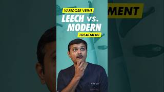 Can Leech Therapy REALLY Cure Varicose Veins [upl. by Hollah]