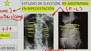 Cirugía general  Obstruccion intestinal ileo post operatorio volvulo instestinal [upl. by Bartko423]