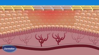 Dermalex Rosacea  How it works [upl. by Akcemat891]