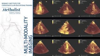 Echo Assessment of Hemodynamics and Echo Assessment of LV Function M Quinones MD amp S Nagueh MD [upl. by Nayrda556]