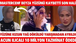 Masterchef Beyzanın Yüzüne Kızgın Yağ Döküldü Son Hali Acun Ilıcalı Tazminat BEYZA YARIŞMADAN ELENDİ [upl. by Enelrak]