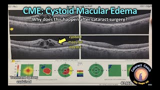 CataractCoach 1461 cystoid macular edema CME after cataract surgery [upl. by Zebadiah154]