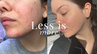 NOT Having a Skincare Routine Saved My Skin [upl. by Ketti]