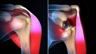 Biomechanical Summary of Reverse Shoulder Arthroplasty [upl. by Sisxela]