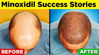 MINOXIDIL  A StepbyStep Guide to Regain Your Hair [upl. by Nahgeam]