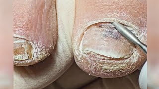 👣How To Pedicure a Toenail Fungus Restoration Process👣 [upl. by Stephanus]