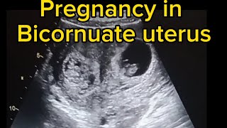 pregnancy in bicornuate uterus ultrasound case [upl. by Brendin]