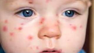 What is chickenpox Signs and symptoms of chickenpox [upl. by Trilbee]