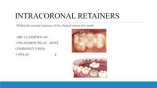 TREATMENT PLANNING FOR FIXED PROSTHODONTICS CONVENTIONAL BRIDGES AND DIAGNOSTIC WAX UP [upl. by Anitsyrhk]