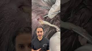 DR SOLOMON explains the removal of epidermoid cyst  DR MEDISPA [upl. by Brig]