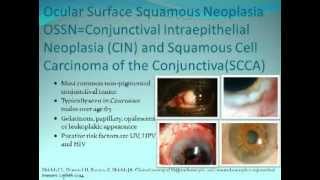 Ocular Surface Squamous Neoplasia  Presenter Carol L Karp MD [upl. by Eeroc615]