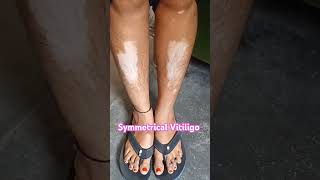 Vitiligo healthtipsinhindi dermatology skindiseases skin charmrog [upl. by Eanom]