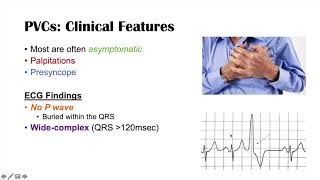 A Common Cause of Palpitations  Premature Ventricular Contractions PVCs Triggers amp Symptoms [upl. by Virgina]