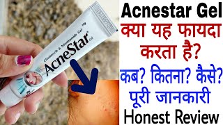 Acnestar Gel Review  Acnestar Gel Kaise Use Kare  Acnestar Gel Ke Fayde [upl. by Enilav951]