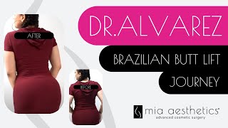 Brazilian Butt Lift BBL By Dr Alvarez At Mia Aesthetics [upl. by Lonna]