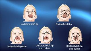 Cleft Diagnosis  Pediatric Playbook  Boston Childrens Hospital [upl. by Gleda]