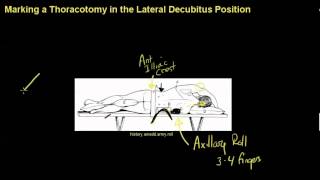 Positioning and marking a thoracotomymp4 [upl. by Schumer870]