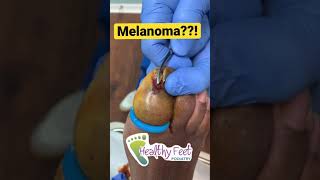 Melanoma Nail cancer [upl. by Minerva519]